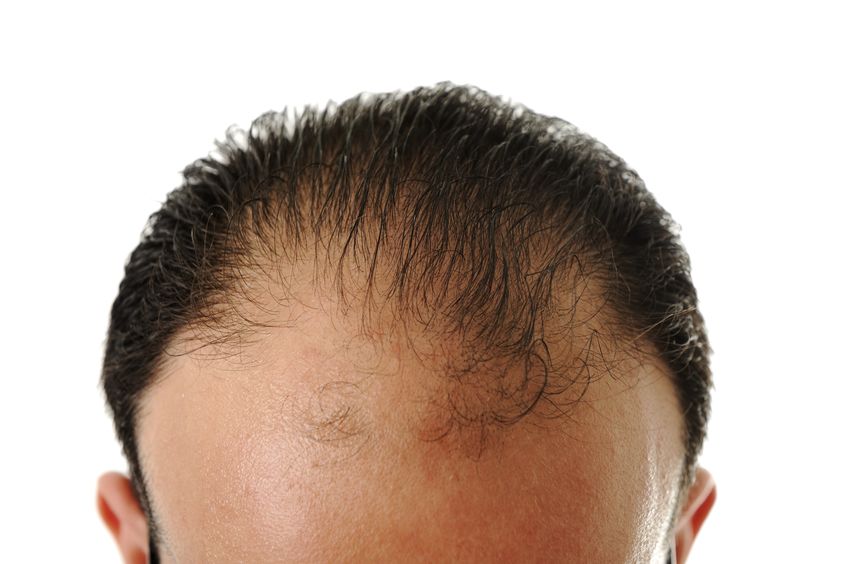 hair loss & thinning hair treatments in limerick hair loss & thinning hair treatments in limerick